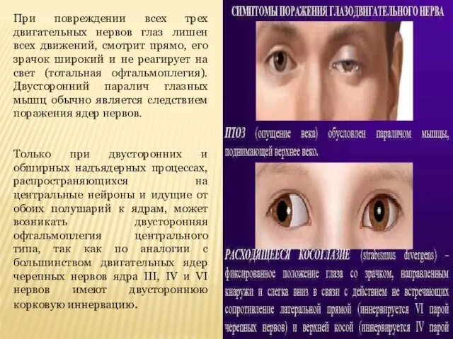 При повреждении всех трех двигательных нервов глаз лишен всех движений, смотрит прямо,