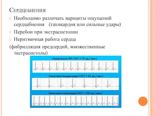 Сердцебиения Необходимо различать варианты ощущений сердцебиения (тахикардия или сильные удары) Перебои при