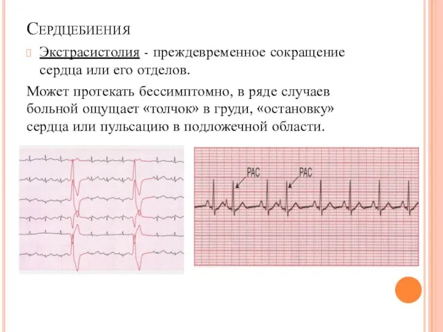 Сердцебиения Экстрасистолия - преждевременное сокращение сердца или его отделов. Может протекать бессимптомно,