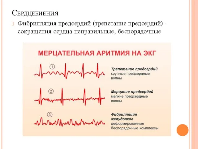Сердцебиения Фибрилляция предсердий (трепетание предсердий) - сокращения сердца неправильные, беспорядочные