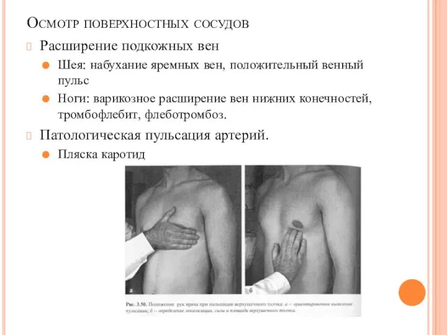 Осмотр поверхностных сосудов Расширение подкожных вен Шея: набухание яремных вен, положительный венный