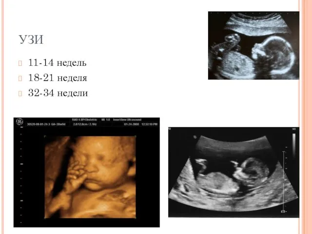 УЗИ 11-14 недель 18-21 неделя 32-34 недели