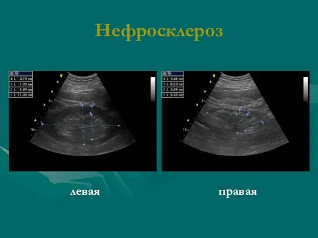Нефросклероз левая правая