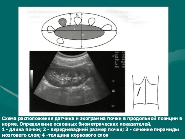 Схема расположения датчика и эхограмма почки в продольной позиции в норме. Определение