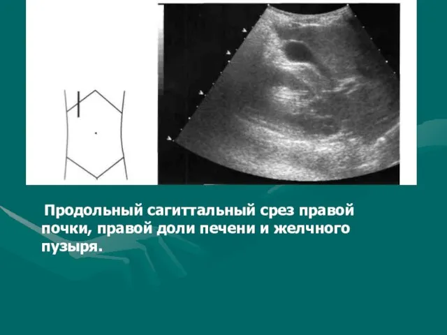 Продольный сагиттальный срез правой почки, правой доли печени и желчного пузыря.