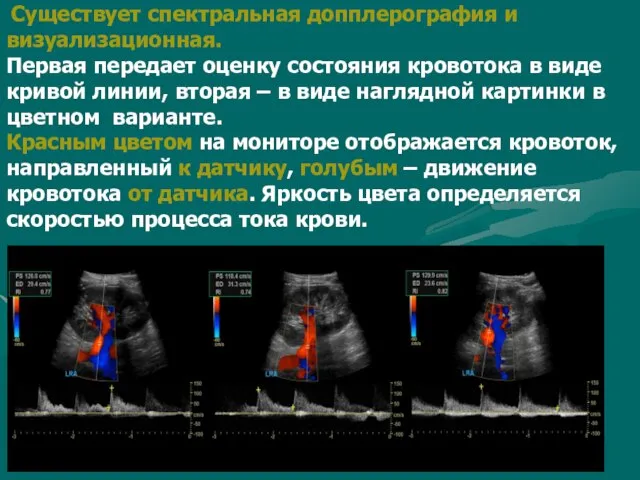 Существует спектральная допплерография и визуализационная. Первая передает оценку состояния кровотока в виде