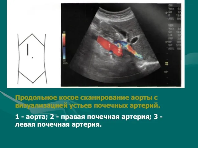 Продольное косое сканирование аорты с визуализацией устьев почечных артерий. 1 - аорта;