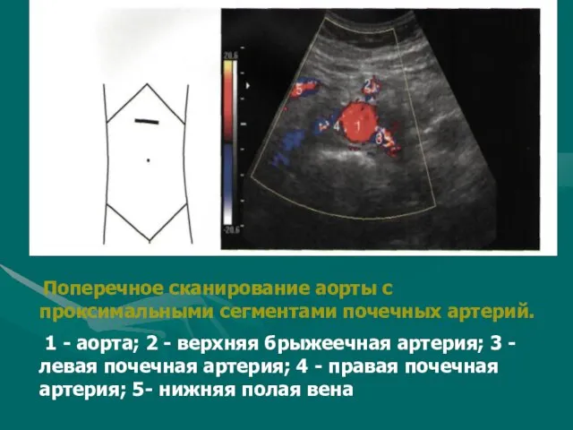Поперечное сканирование аорты с проксимальными сегментами почечных артерий. 1 - аорта; 2