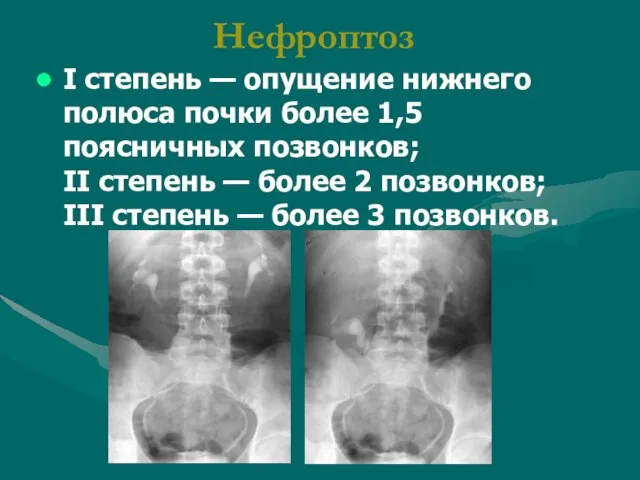 I степень — опущение нижнего полюса почки более 1,5 поясничных позвонков; II