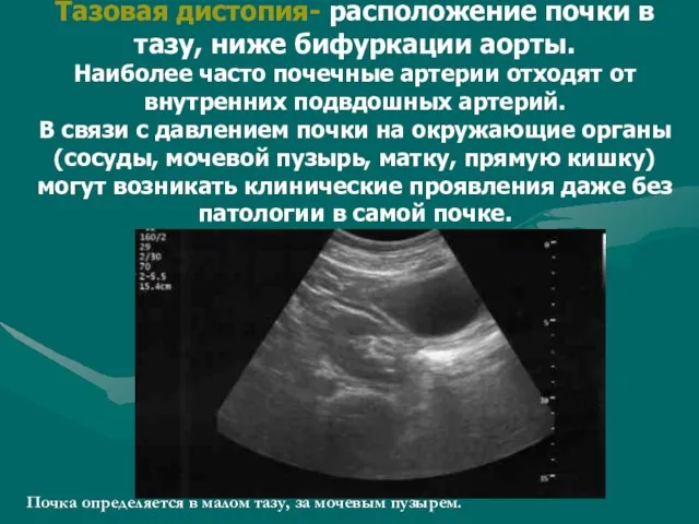 Тазовая дистопия- расположение почки в тазу, ниже бифуркации аорты. Наиболее часто почечные