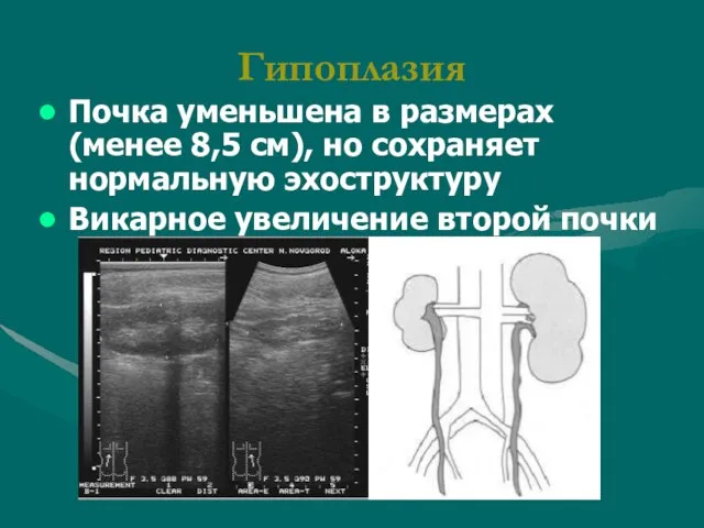 Гипоплазия Почка уменьшена в размерах (менее 8,5 см), но сохраняет нормальную эхоструктуру Викарное увеличение второй почки