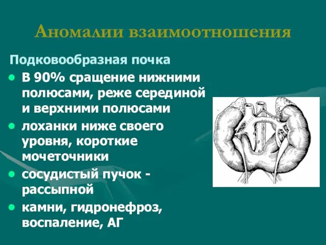 Аномалии взаимоотношения Подковообразная почка В 90% сращение нижними полюсами, реже серединой и