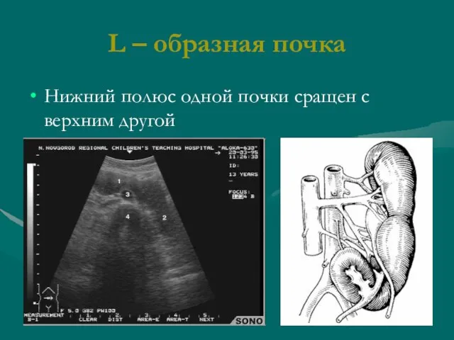 L – образная почка Нижний полюс одной почки сращен с верхним другой