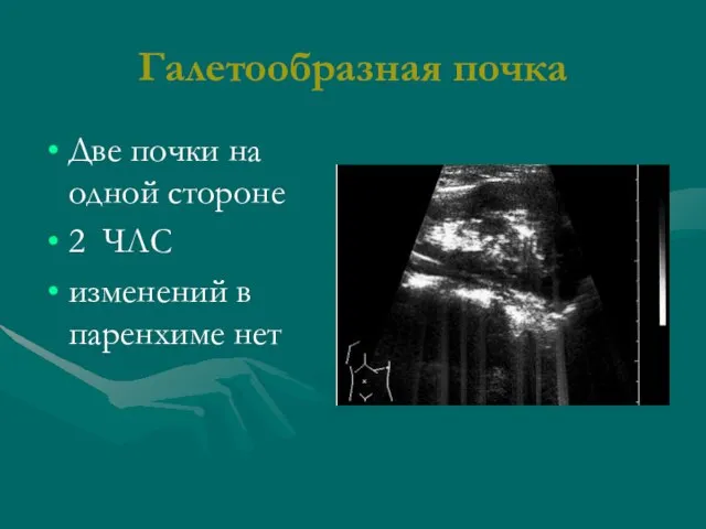 Галетообразная почка Две почки на одной стороне 2 ЧЛС изменений в паренхиме нет