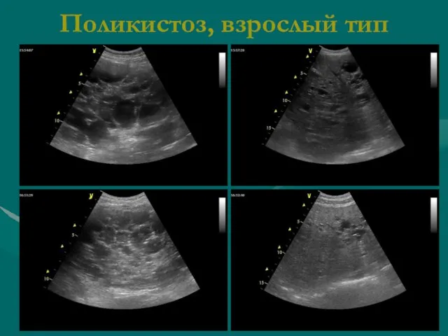 Поликистоз, взрослый тип