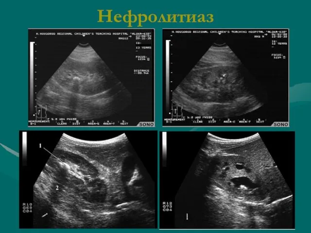 Нефролитиаз