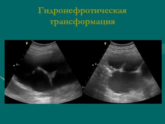 Гидронефротическая трансформация