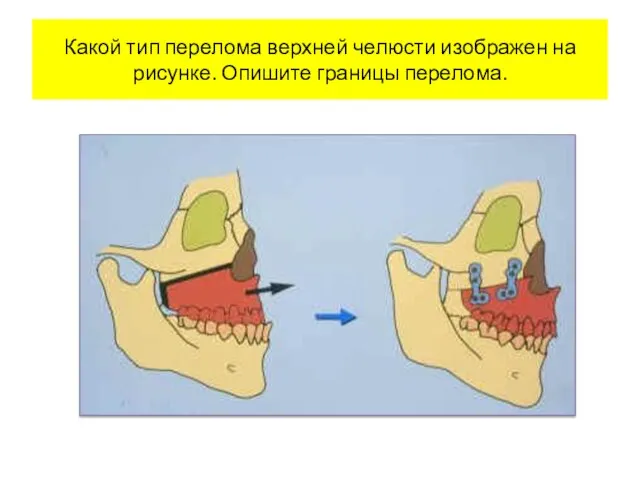 Какой тип перелома верхней челюсти изображен на рисунке. Опишите границы перелома.