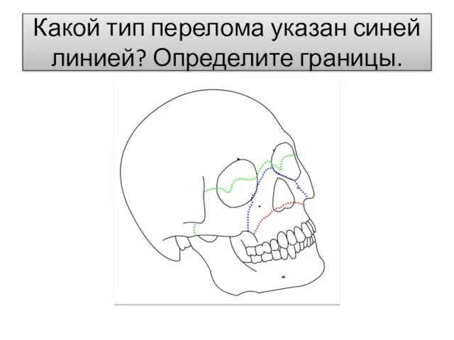 Какой тип перелома указан синей линией? Определите границы.