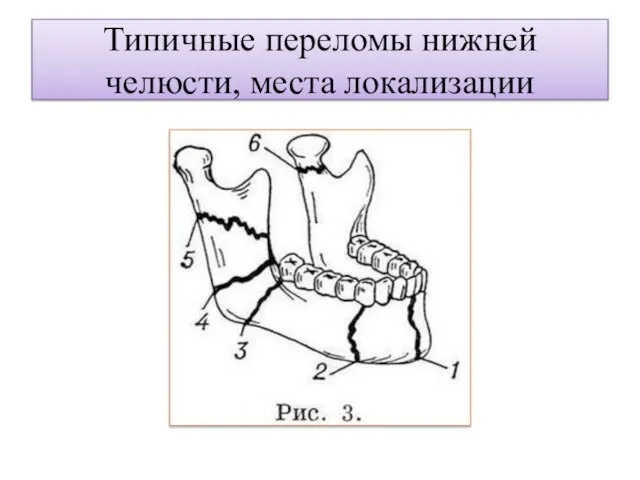 Типичные переломы нижней челюсти, места локализации