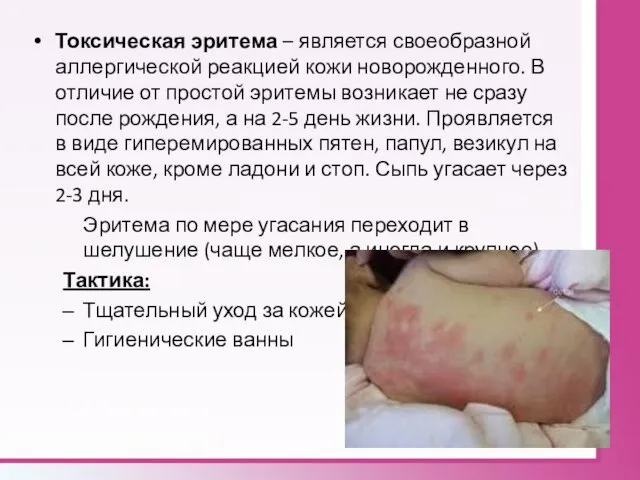Токсическая эритема – является своеобразной аллергической реакцией кожи новорожденного. В отличие от