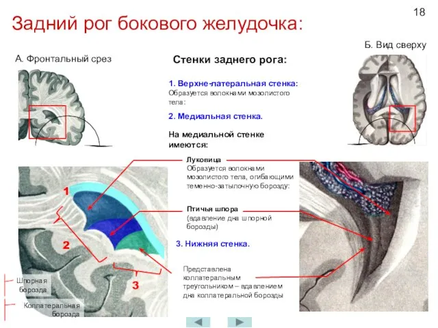 Задний рог бокового желудочка: А. Фронтальный срез Б. Вид сверху Стенки заднего