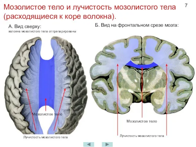 Мозолистое тело и лучистость мозолистого тела (расходящиеся к коре волокна). А. Вид