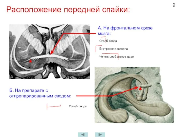 Расположение передней спайки: А. На фронтальном срезе мозга: Столб свода Внутренняя капсула