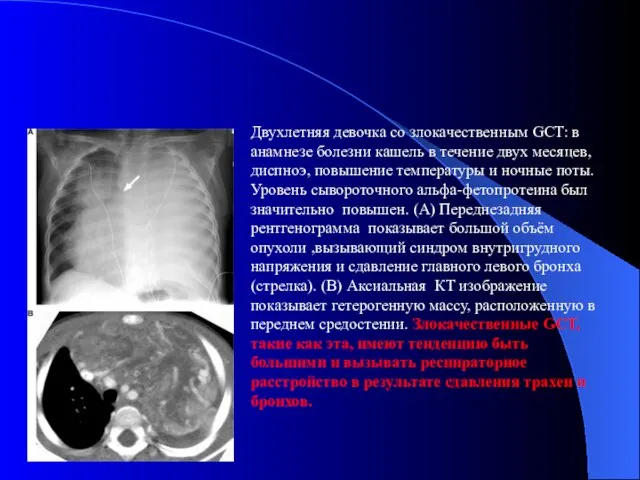 Двухлетняя девочка со злокачественным GCT: в анамнезе болезни кашель в течение двух