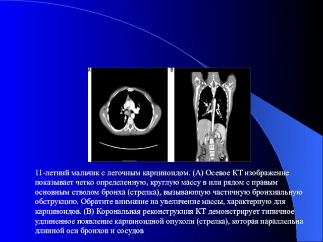 11-летний мальчик с легочным карциноидом. (A) Осевое КТ изображение показывает четко определенную,