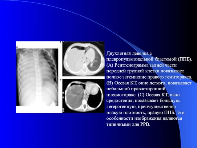 Двухлетняя девочка с плевропульмональной бластомой (ППБ). (A) Рентгенограмма задней части передней грудной