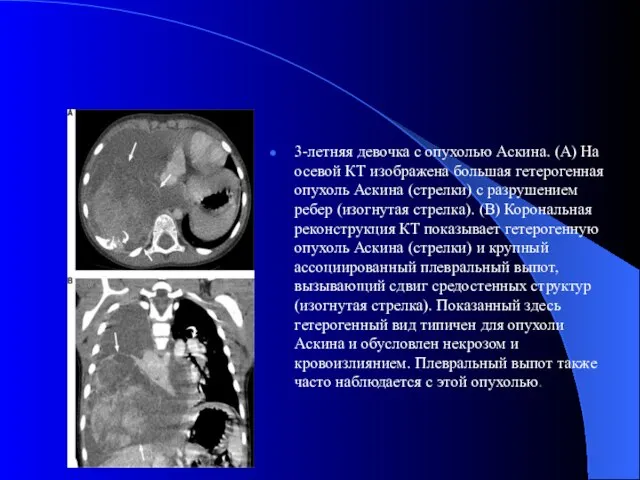 3-летняя девочка с опухолью Аскина. (A) На осевой КТ изображена большая гетерогенная