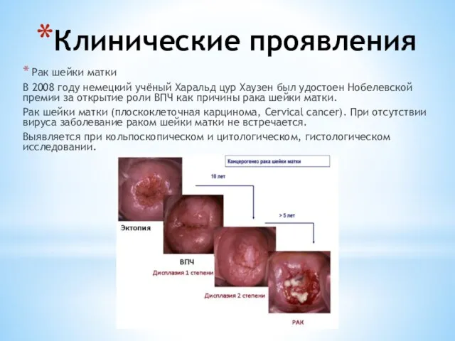 Клинические проявления Рак шейки матки В 2008 году немецкий учёный Харальд цур