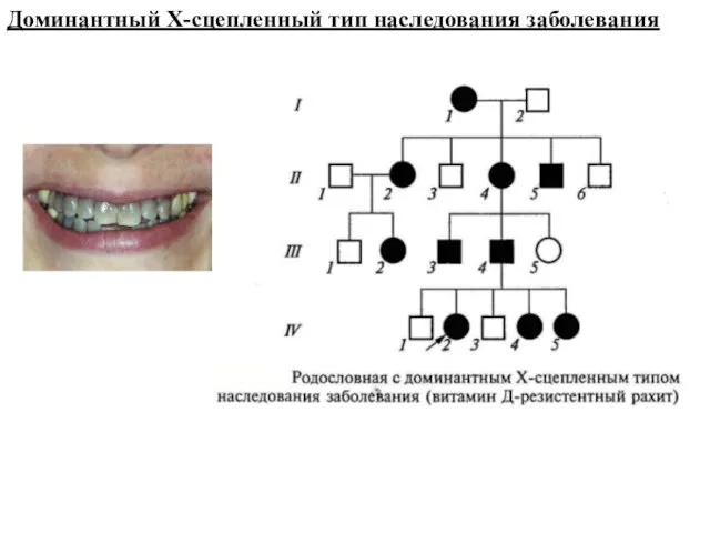 Доминантный Х-сцепленный тип наследования заболевания