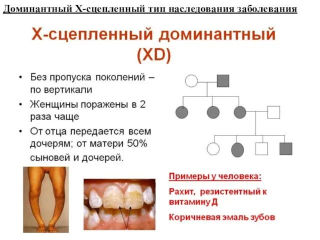 Доминантный Х-сцепленный тип наследования заболевания