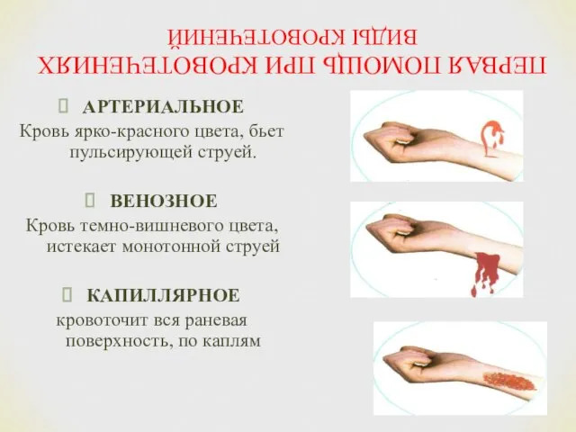 ПЕРВАЯ ПОМОЩЬ ПРИ КРОВОТЕЧЕНИЯХ ВИДЫ КРОВОТЕЧЕНИЙ АРТЕРИАЛЬНОЕ Кровь ярко-красного цвета, бьет пульсирующей