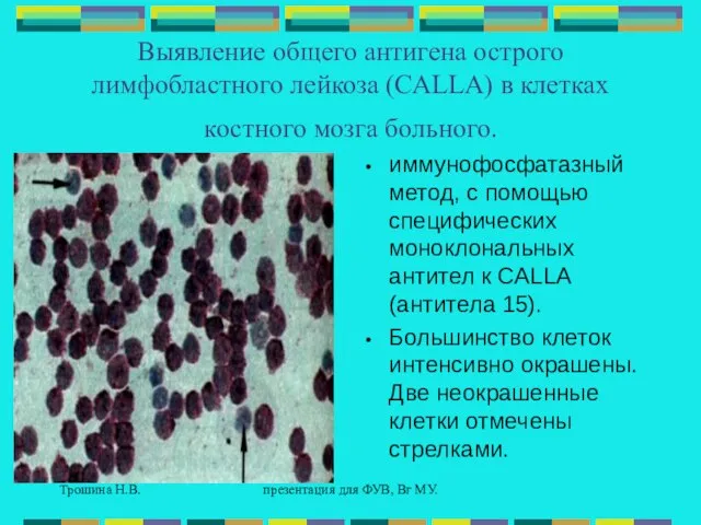Трошина Н.В. презентация для ФУВ, Вг МУ. Выявление общего антигена острого лимфобластного