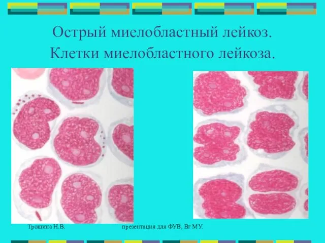 Трошина Н.В. презентация для ФУВ, Вг МУ. Острый миелобластный лейкоз. Клетки миелобластного лейкоза.