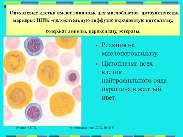 Трошина Н.В. презентация для ФУВ, Вг МУ. Опухолевые клетки имеют типичные для