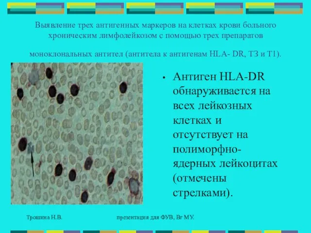 Трошина Н.В. презентация для ФУВ, Вг МУ. Выявление трех антигенных маркеров на
