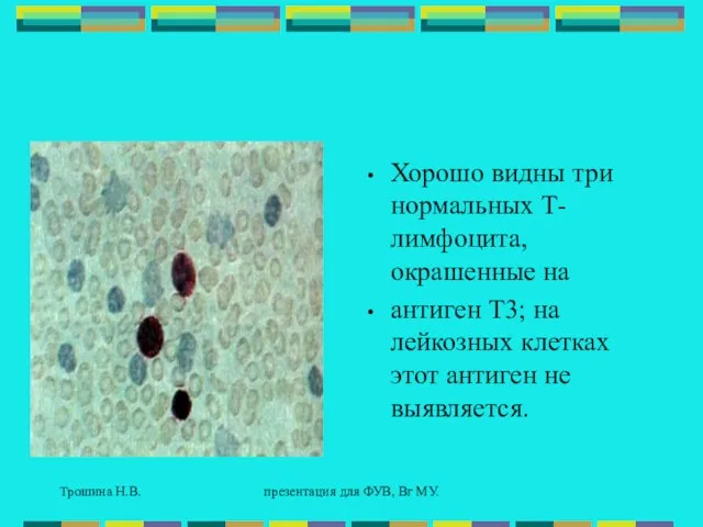 Трошина Н.В. презентация для ФУВ, Вг МУ. Хорошо видны три нормальных Т-лимфоцита,