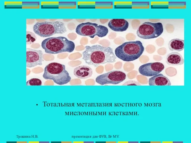 Трошина Н.В. презентация для ФУВ, Вг МУ. Тотальная метаплазия костного мозга миеломными клетками.