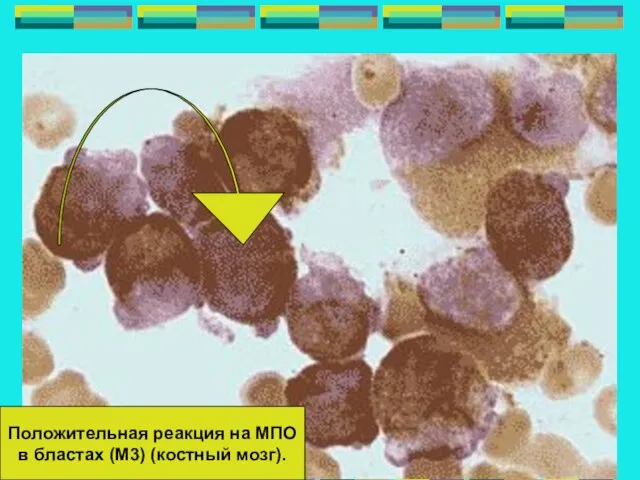 Положительная реакция на МПО в бластах (М3) (костный мозг).