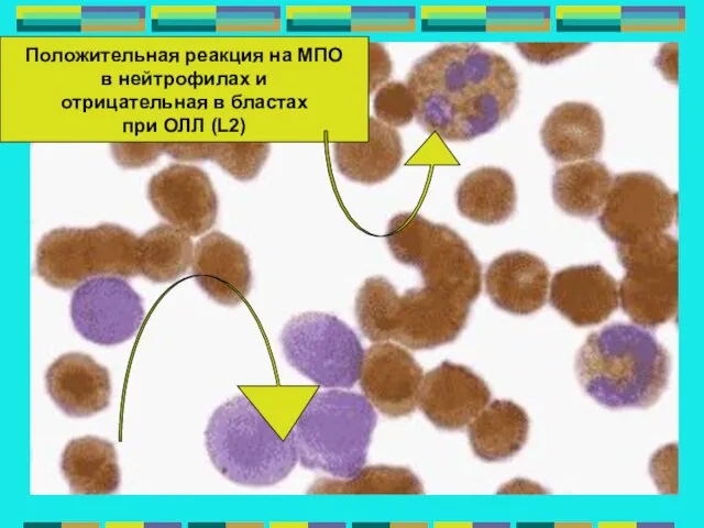 Положительная реакция на МПО в нейтрофилах и отрицательная в бластах при ОЛЛ (L2)