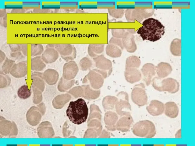 Положительная реакция на липиды в нейтрофилах и отрицательная в лимфоците.