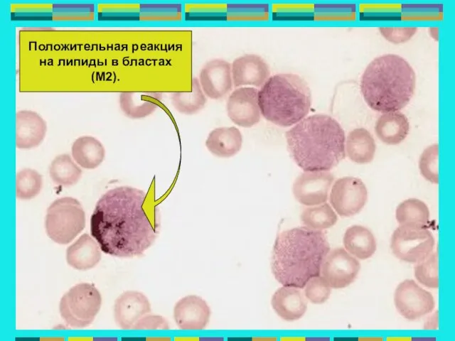 Положительная реакция на липиды в бластах (М2).