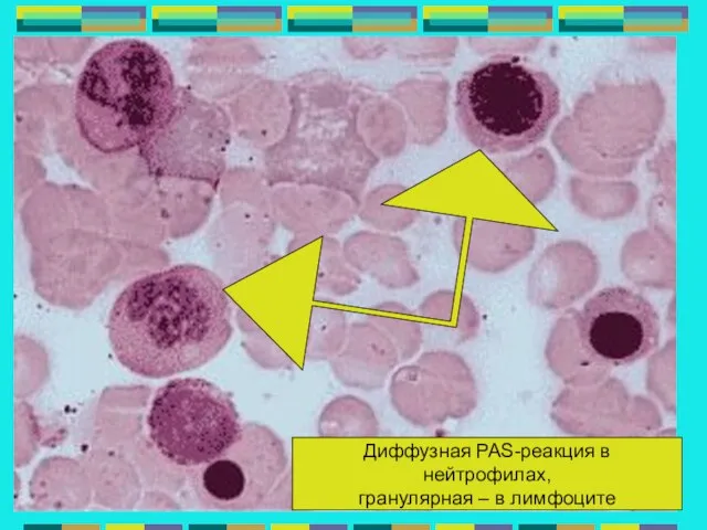 Диффузная PAS-реакция в нейтрофилах, гранулярная – в лимфоците