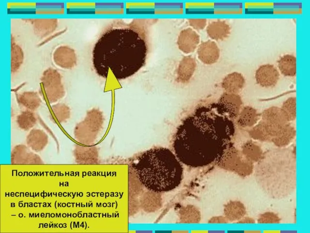 Положительная реакция на неспецифическую эстеразу в бластах (костный мозг) – о. миеломонобластный лейкоз (М4).