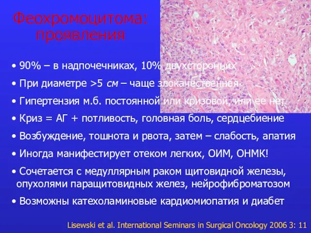 Феохромоцитома: проявления 90% – в надпочечниках, 10% двухсторонних При диаметре >5 см