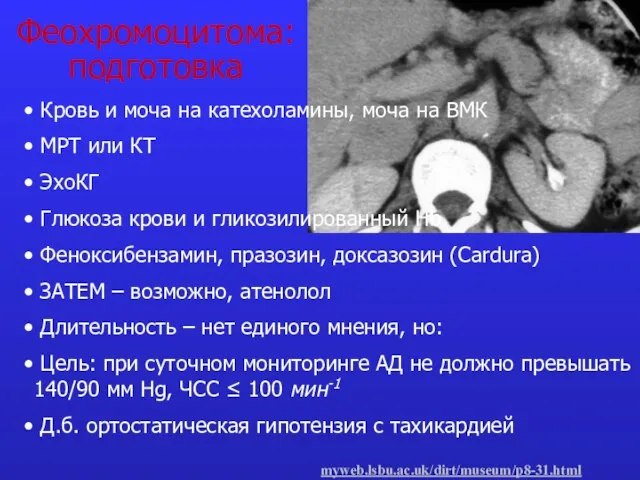 Феохромоцитома: подготовка Кровь и моча на катехоламины, моча на ВМК МРТ или